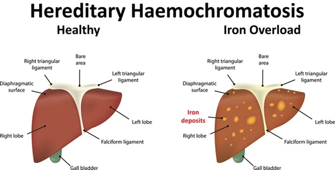 Hereditary Haemochromatosis. Image Credit: Joshya / Shutterstock