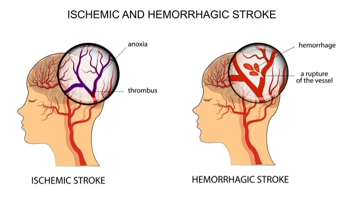 Illustration of the vessels of the brain and a brief description of the causes of stroke. Image Credit: Artemida-psy / Shutterstock
