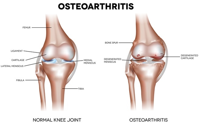 Knee Osteoarthritis and normal joint detailed anatomy. Image Credit: Tefi / Shutterstock