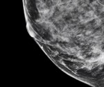 Microcalcifications in Breast Cancer