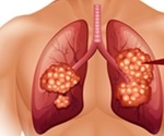 Lung Cancer Screening Procedure