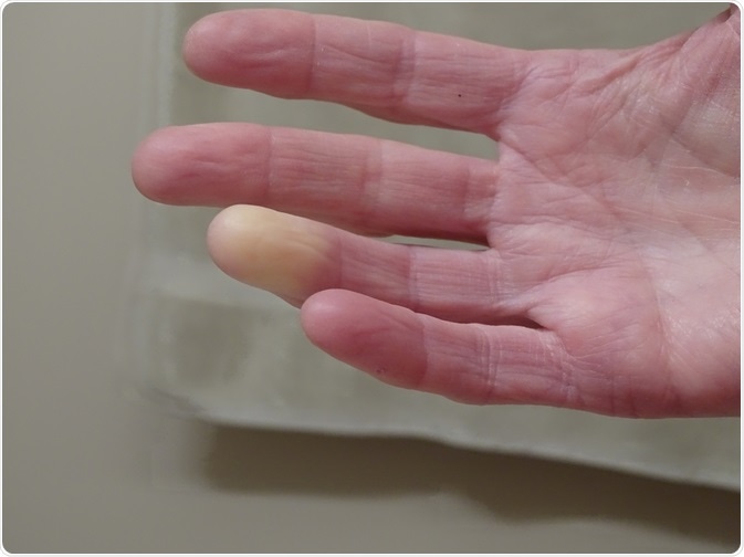Picture of patient with Raynaud