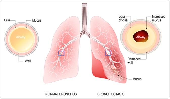Bronchiectasis. Normal bronchus and bronchiectasis. Enlarged small airways that collect mucus and cause recurrent lung infections. Image Credit: Designua / Shutterstock