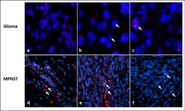 Researchers uncover novel molecular clues for tumor aggression in neurofibromatosis type 1