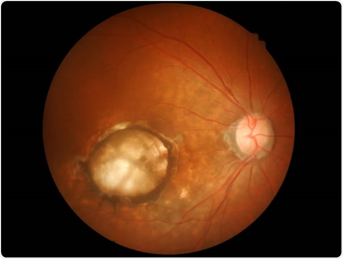 Age-related macular degeneration (AMD). Image Credit: Memorisz / Shutterstock