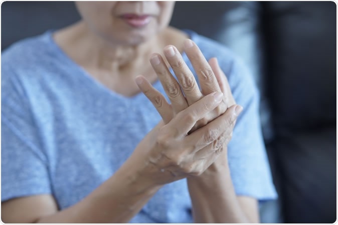 No studies have assessed the effect of methotrexate (MTX) in osteoarthritis of the hand (HOA). The purpose of this study was to examine the effect of MTX on pain and structural progression in symptomatic erosive HOA (EHOA). - Image Credit: one photo / Shutterstock