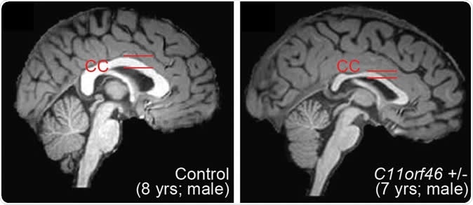 Healthy human brain (left) and brain with WAGR syndrome, in which the corpus callosum is thinner and misformed. Image Credit: Nature Communications