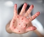 Misinformation is causing measles cases to rise worldwide