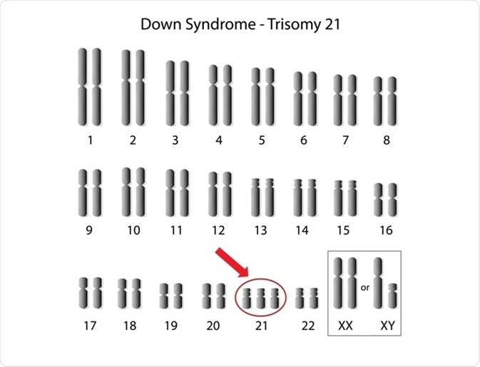 Down syndrome is caused by aneuploidy of chromosome 21