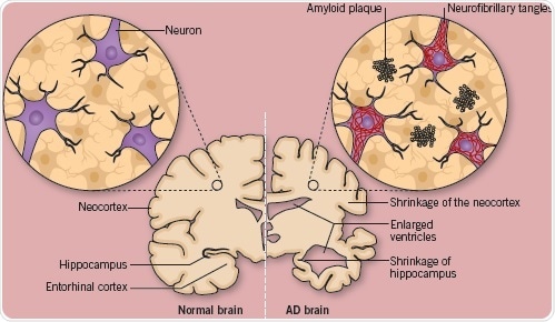 A comparison of a normal, healthy brain, with a brain affected with advanced Alzheimer