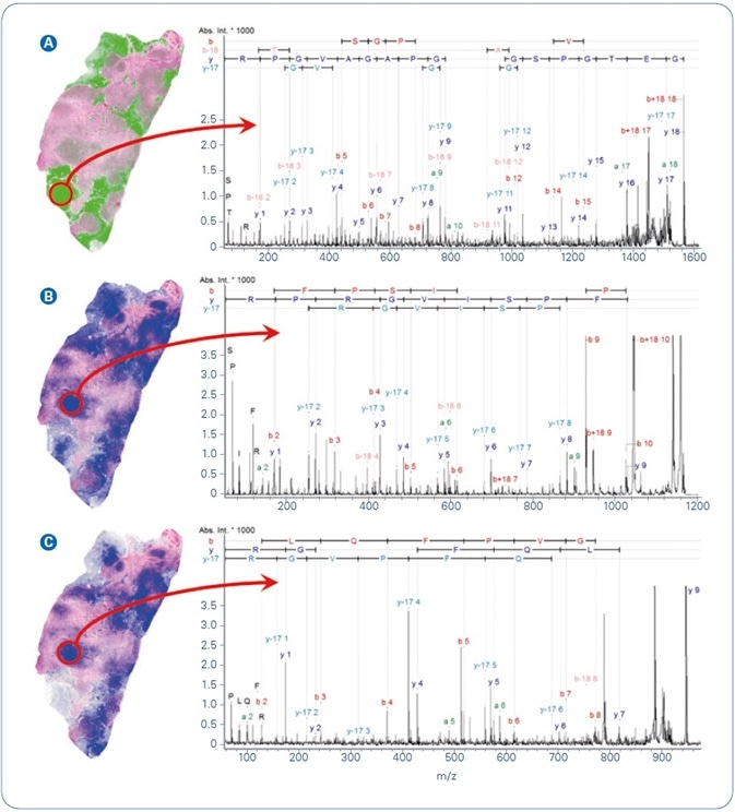 Selected MALDI ion images from FFPE human breast cancer tissue overlayed with co-registered H&E. Peptide identification was achieved by MALDI-MS/MS directly from tissue. (A) m/z 1562.8, GETGPSGPVGPAGAVGPR from Collagen alpha 2; (B) m/z 1198.7, AVFPSIVGRPR from Actin, cytoplasmic 1; (C) m/z 944.5, AGLQFPVGR from Histone H2AV.