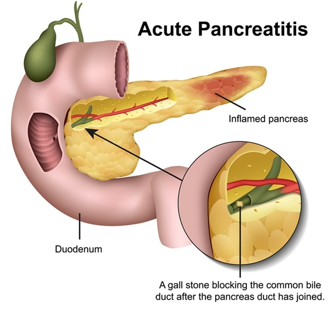 Acute pancreatitis 3d illustration. Image Credit: medicalstocks / Shutterstock