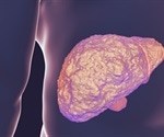 What is Cirrhosis?