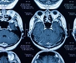 Obesity linked to a reduction in gray matter