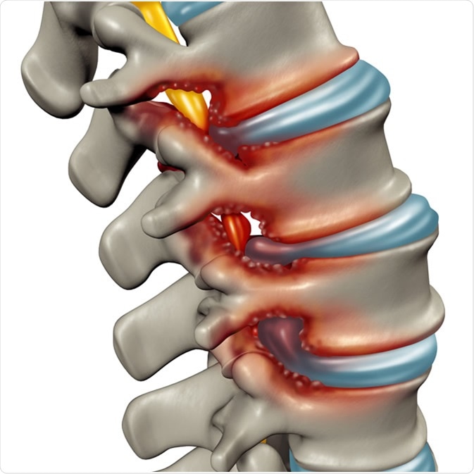 Spinal Stenosis as a degenerative illness in the human vertebrae causing compressed spine nerves medical concept as a 3D illustration. Credit: Lightspring / Shutterstock