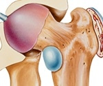 What is Trochanteric Bursitis?