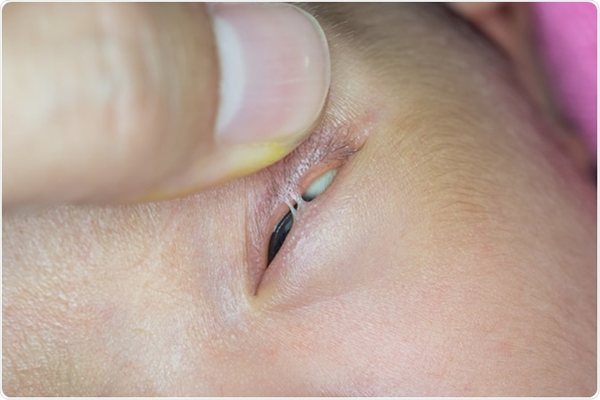 Close up of Ankyloblepharon Filiforme Adnatum during eye examination. Image Credit: ARZTSAMUI / Shutterstock