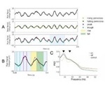 Novel measures of PD-related brain activity detected with scalp electroencephalography