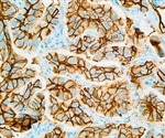 Study identifies C1orf122 as prognostic marker in liver cancer