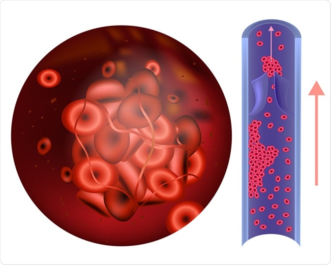 Prothrombin thrombophilia. (sometimes hypercoagulability or a prothrombotic state) Image Credit: Sakurra / Shutterstock