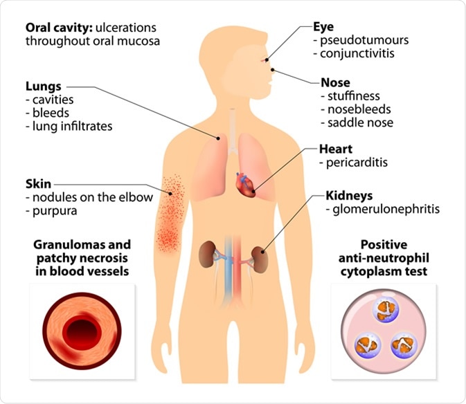 Granulomatosis with polyangiitis (GPA). Image Credit: Designua / Shutterstock