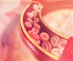 PCSK9 inhibitor combined with a statin may help reduce LDL cholesterol after heart transplant