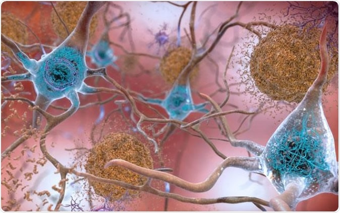 In brains affected by Alzheimer