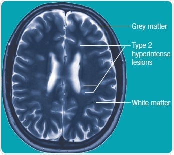 MRI scan of an MS brain T2 weighted axial view of MRI brain scan from a patient with relapsing-remitting MS. Multiple white matter T2 hyperintense lesions in orientation and distribution typical for MS. MRI scan of an MS brain T2 weighted axial view of MRI brain scan from a patient with relapsing-remitting MS. Multiple white matter T2 hyperintense lesions in orientation and distribution typical for MS.