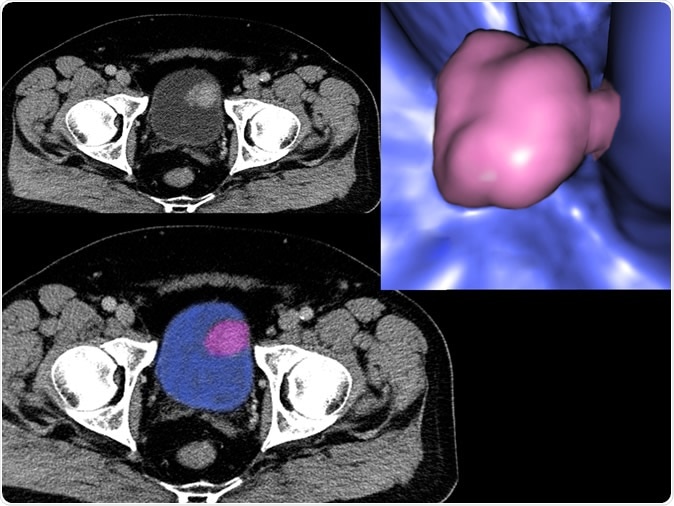 Bladder cancer, CT - Illustration Credit: Semnic / Shutterstock