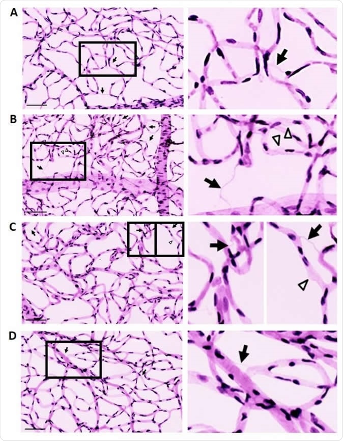 Effect of recombinant lysyl oxidase propeptide (rLOX-PP) on the development of acellular capillaries (ACs) and pericyte loss (PL) in rat retinas. A-D: Representative retinal trypsin digest images showing retinal vascular networks of a control rat (A), diabetic (DM) rat (B), rat intravitreally injected with rLOX-PP (C), and rat intravitreally injected with phosphate-buffered saline (PBS) (D). LOX-PP administration promoted the development of ACs (arrows) and PL (arrowheads) associated with diabetic retinopathy. Enlarged images correspond to boxed areas (Right panels of A, B, C, D). Scale bar = 100 μm. Image Credit: The American Journal of Pathology