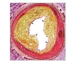 Atherosclerosis Cardiovascular Research