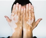 Microbial compound offers hope for vitiligo treatment