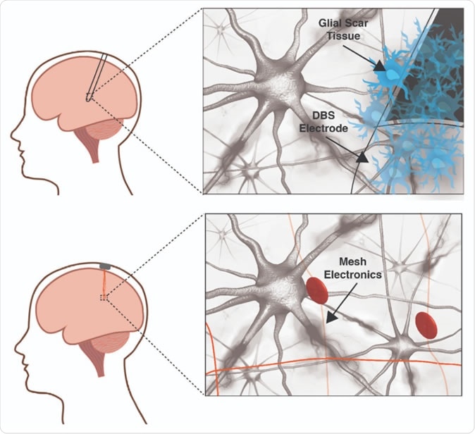 A traditional deep brain stimulation electrode (top panel) provokes an immune response in the brain while a mesh electronic interface (bottom panel) does not. The size and rigidity of the DBS electrode result in chronic inflammation causing glial scarring between brain tissue and electrode, degrading the neural interface. Mesh electronics evade the immune response due to cellular and sub-cellular features and bending stiffness resembling the brain itself. Image courtesy of Shaun Patel and Charles Lieber
