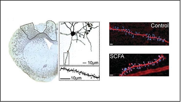 Short chain fatty acid supplementation improves stroke recovery, mice study shows Short chain fatty acid supplementation improves stroke recovery, mice study shows