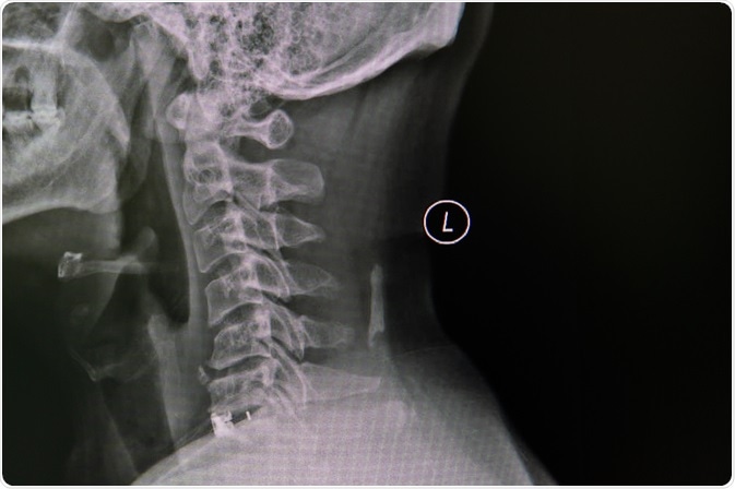 Cervical Spondylosis