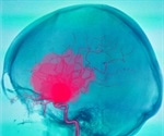 Can Artificial Intelligence be used to Diagnose Brain Aneurysms?