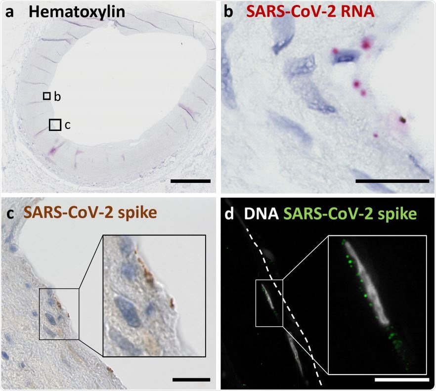 (a) Overview shows a cross section of an A. carotis counterstained with Hematoxylin and subjected to in situ SARS-CoV-2 RNA hybridization. (b) Close up of boxed region B in (a). (c) Close up of boxed region C, which depicts immunohistochemical staining of SARS-CoV-2 spike protein in a section consecutive to (a). (d) Immunofluorescence staining of nuclei and spike protein in endothelial cells seen in a section consecutive to the section shown in (a). Scale bars represent 300 μm (a) and 20 μm (b, c, d).