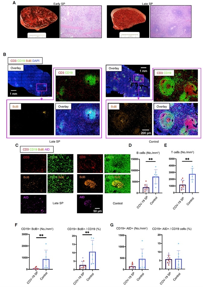 White Pulp Attrition, Early Loss of Germinal Centers, and Bcl-6-Expressing B Cells in COVID-19 Spleens.
