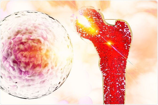 Bone Cancer with stem cell