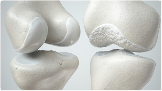 Healthy and osteoarthritis-covered knee - 3D render. Crevis / Shutterstock