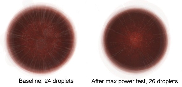 Patterns and cracks from dried blood droplets could indicate specific health conditions