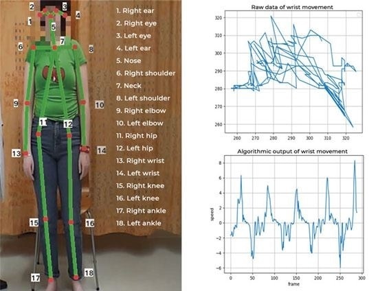 Automatic method to assess severity of myoclonic jerks from video footage