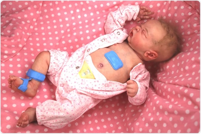The wireless sensors (in blue) displayed on a model neonate in the lab. Image Credit: Northwestern University