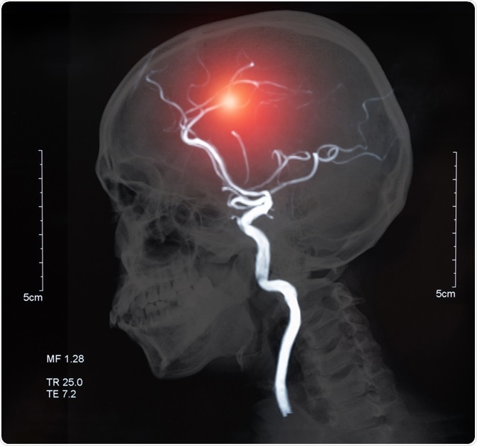 Cerebrovascular Disease Cerebrovascular Disease