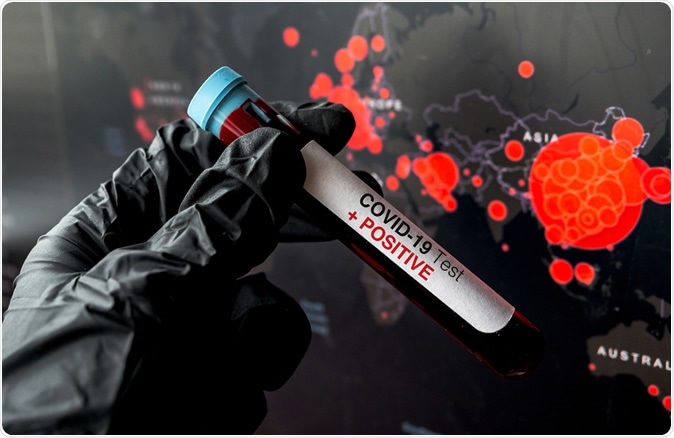 Epidemiology and transmission of COVID-19 in 391 cases and 1286 of their close contacts in Shenzhen, China: a retrospective cohort study. Image Credit: DigitalMammoth / Shutterstock