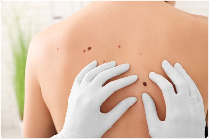 Skin Cancer Skin Cancer