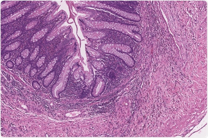 Subtotal Colectomy Subtotal Colectomy