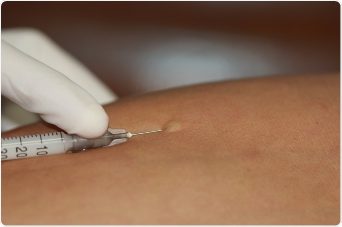 Penicillin Skin Testing