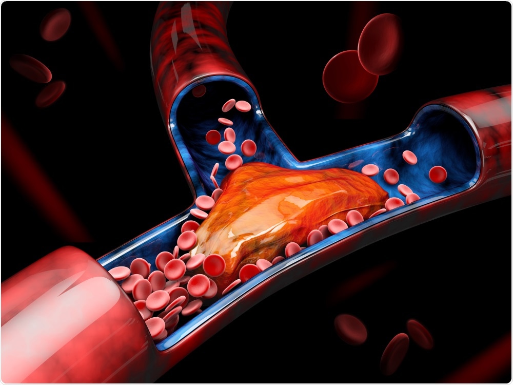 Study: Venous Thrombosis Among Critically Ill Patients With Coronavirus Disease 2019 (COVID-19). Image Credit: Victor Josan / Shutterstock