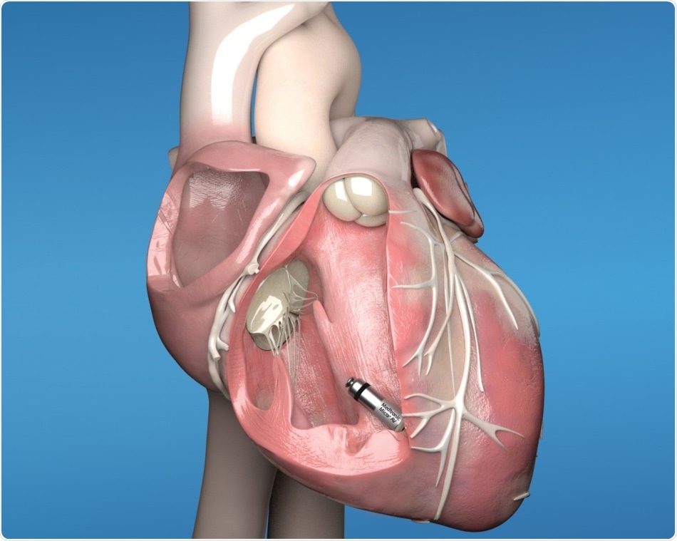 Glenfield Hospital first in the UK and Ireland to implant world’s smallest, wireless pacemaker